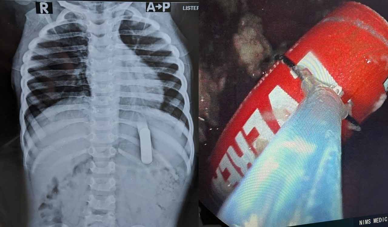 Kerala doctors save 2-year-old kid who swallowed TV remote battery