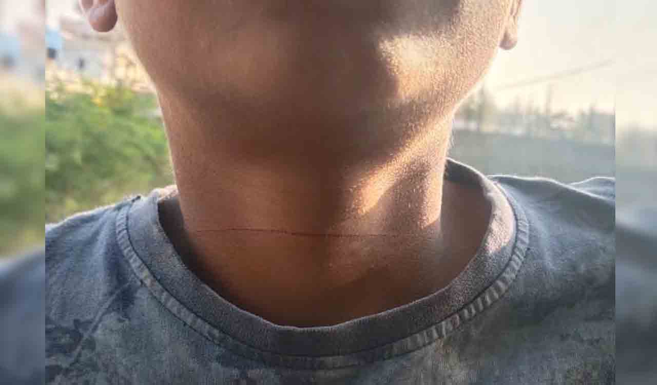 Sangareddy: Nylon manja gets entangled on boy’s throat in Ameenpur