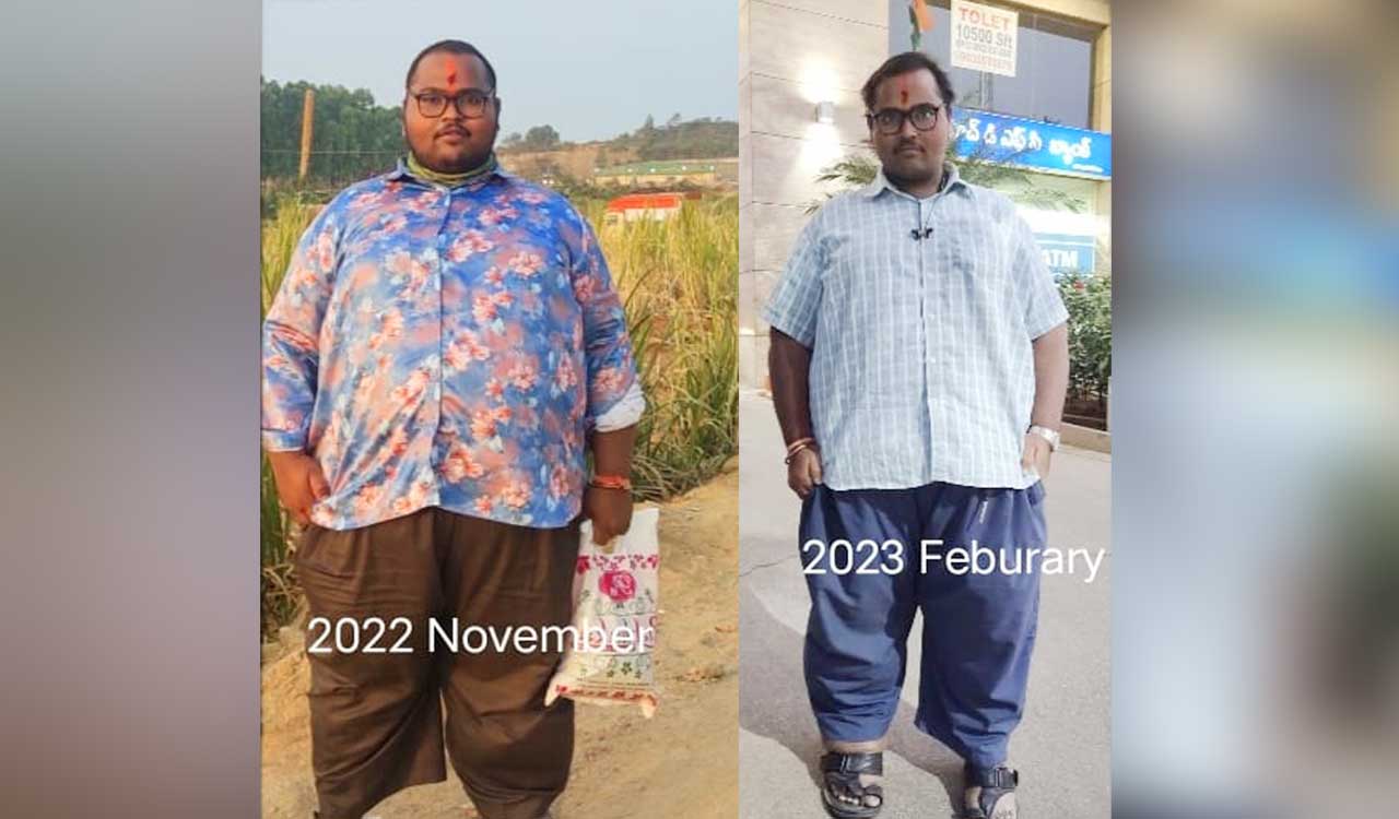 Super-obese patient loses 70 kgs after bariatric surgery at Osmania General Hospital