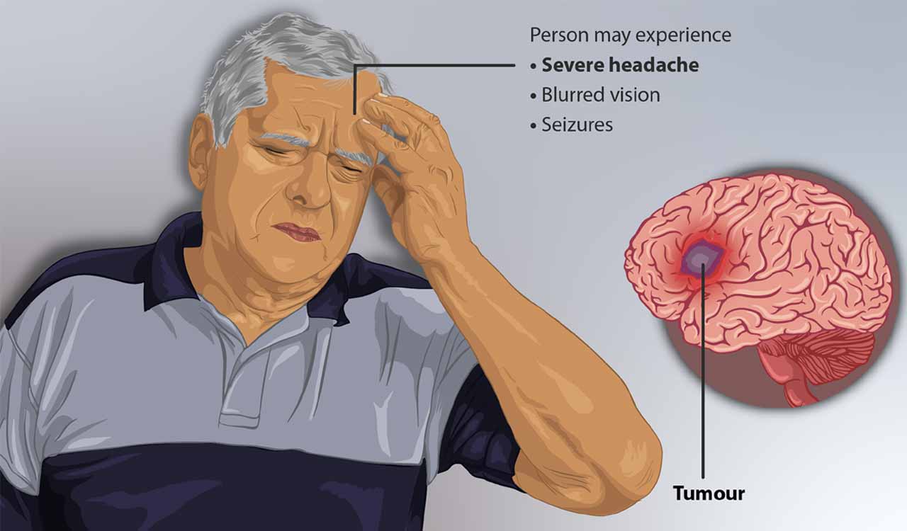 Brain tumour could now be detected using urine test