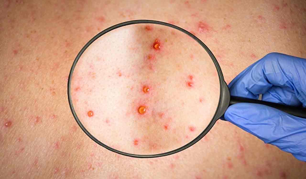 20 school kids, one teacher infected with chickenpox in UP’s Ballia