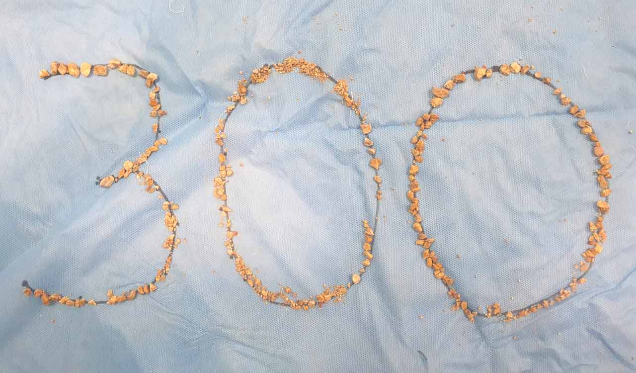 300 kidney stones removed at AINU on a 75-year-old patient