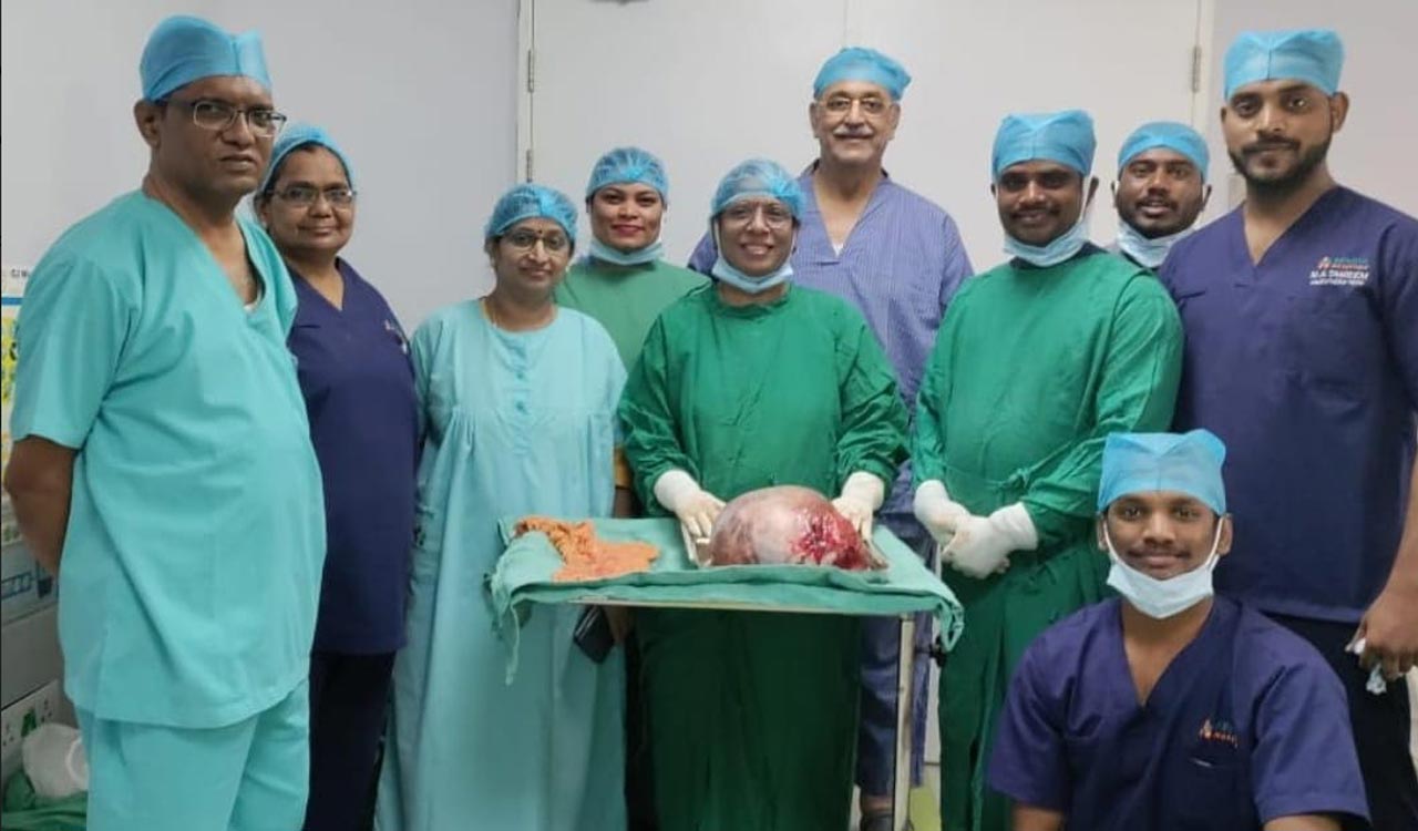 Hyderabad: Ovarian tumor weighing 5 kgs removed