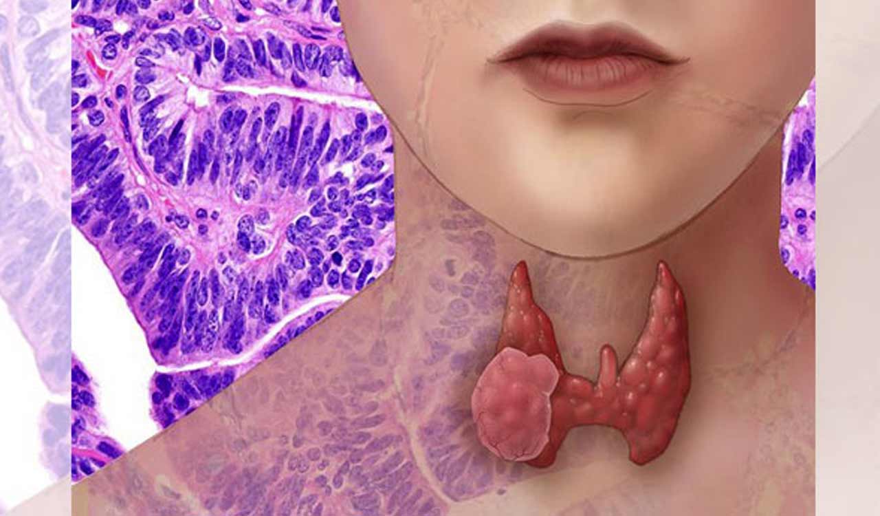 Attention thyroid medication users! Abbott issues urgent recall on mislabelled batch – Check yours now