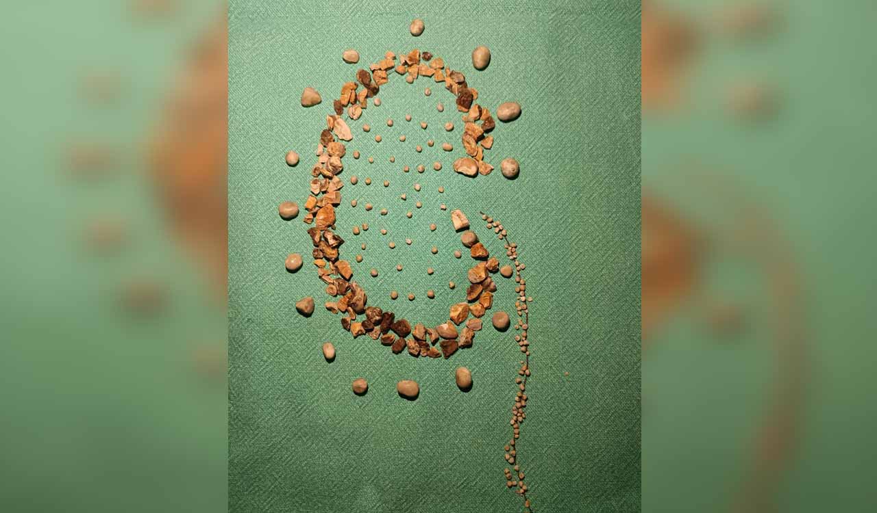 Urologists remove 154 stones from right kidney in a 45-year-old man