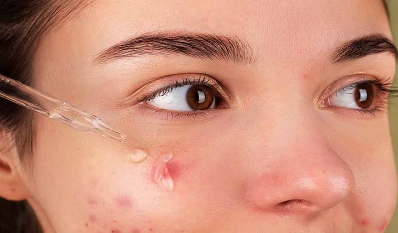 What causes warts and how to get rid of them?