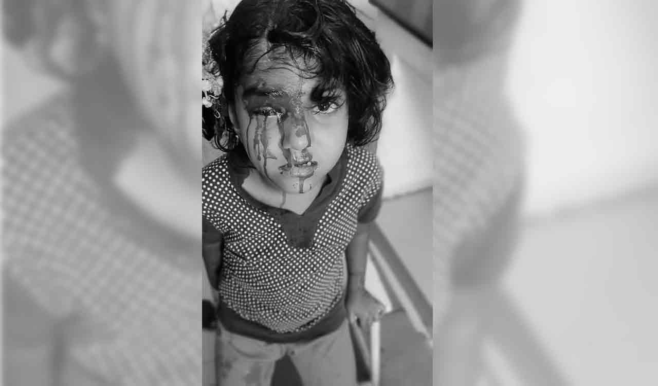Medak: Girl injured on head in street dog attack in Narsapur