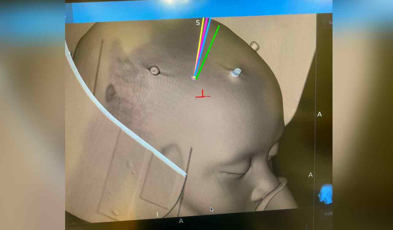 Hyderabad: 3-year-old boy with laughing seizures treated at AIG Hospitals