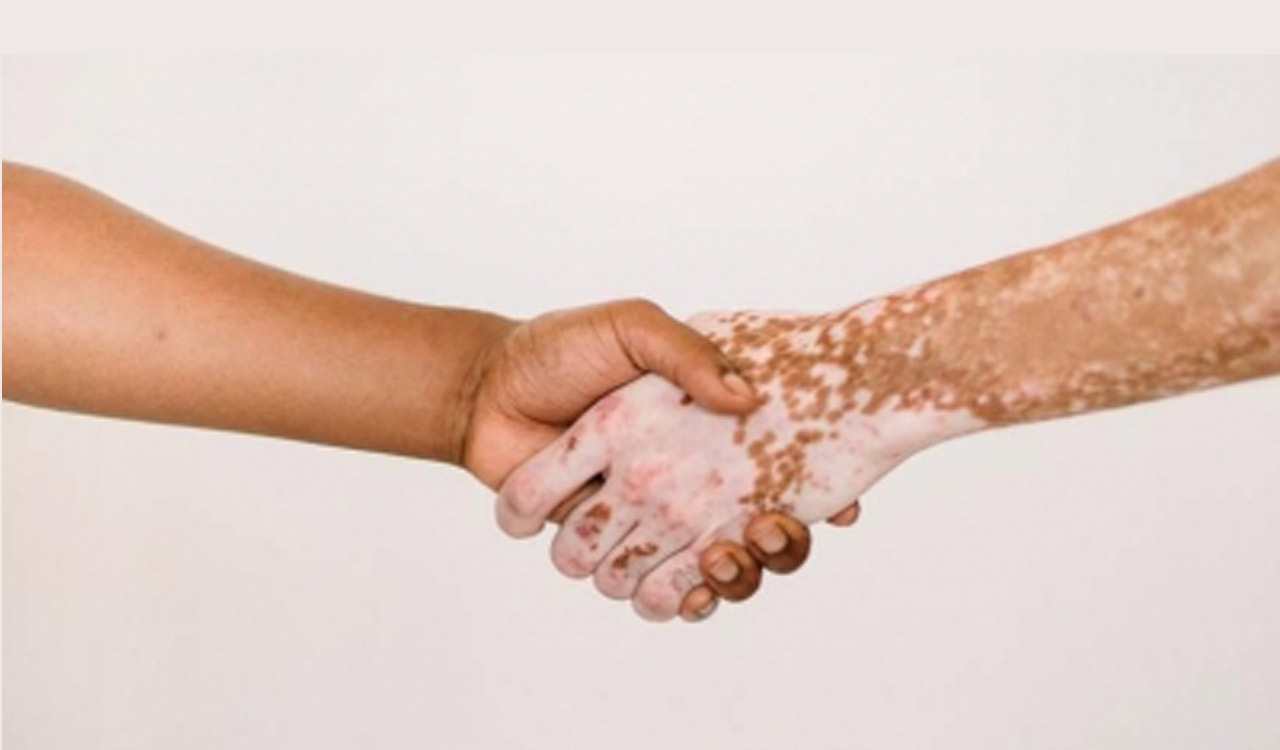 Indian subcontinent tops global charts with highest prevalence of vitiligo