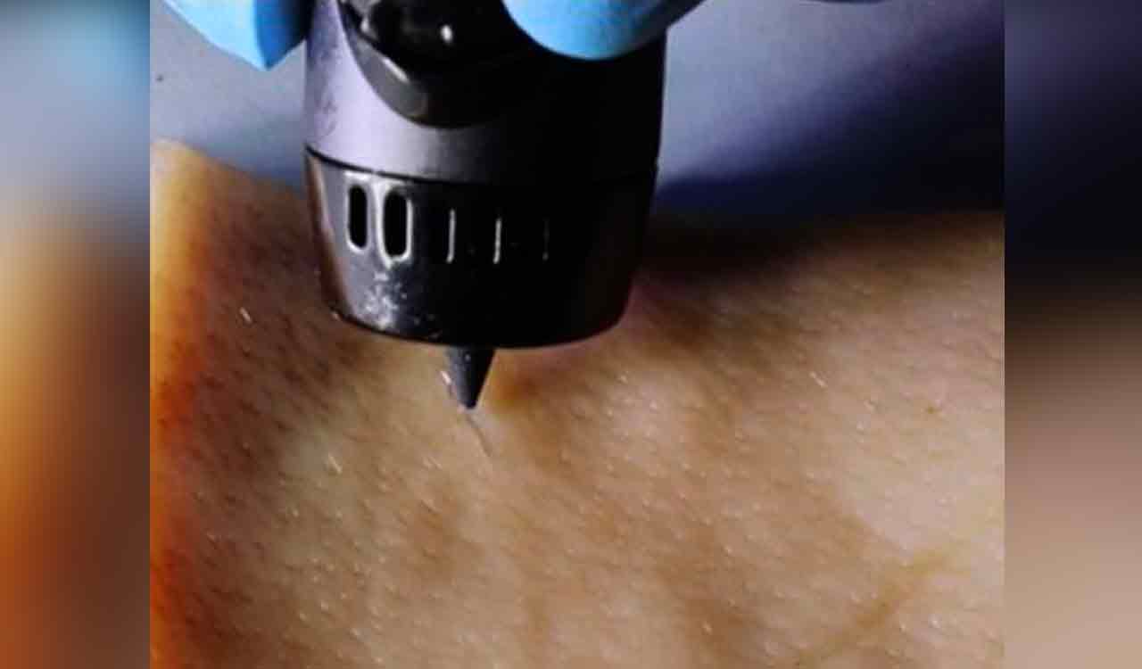 New wound-healing ink repairs cuts with a 3D-printing pen-Telangana Today