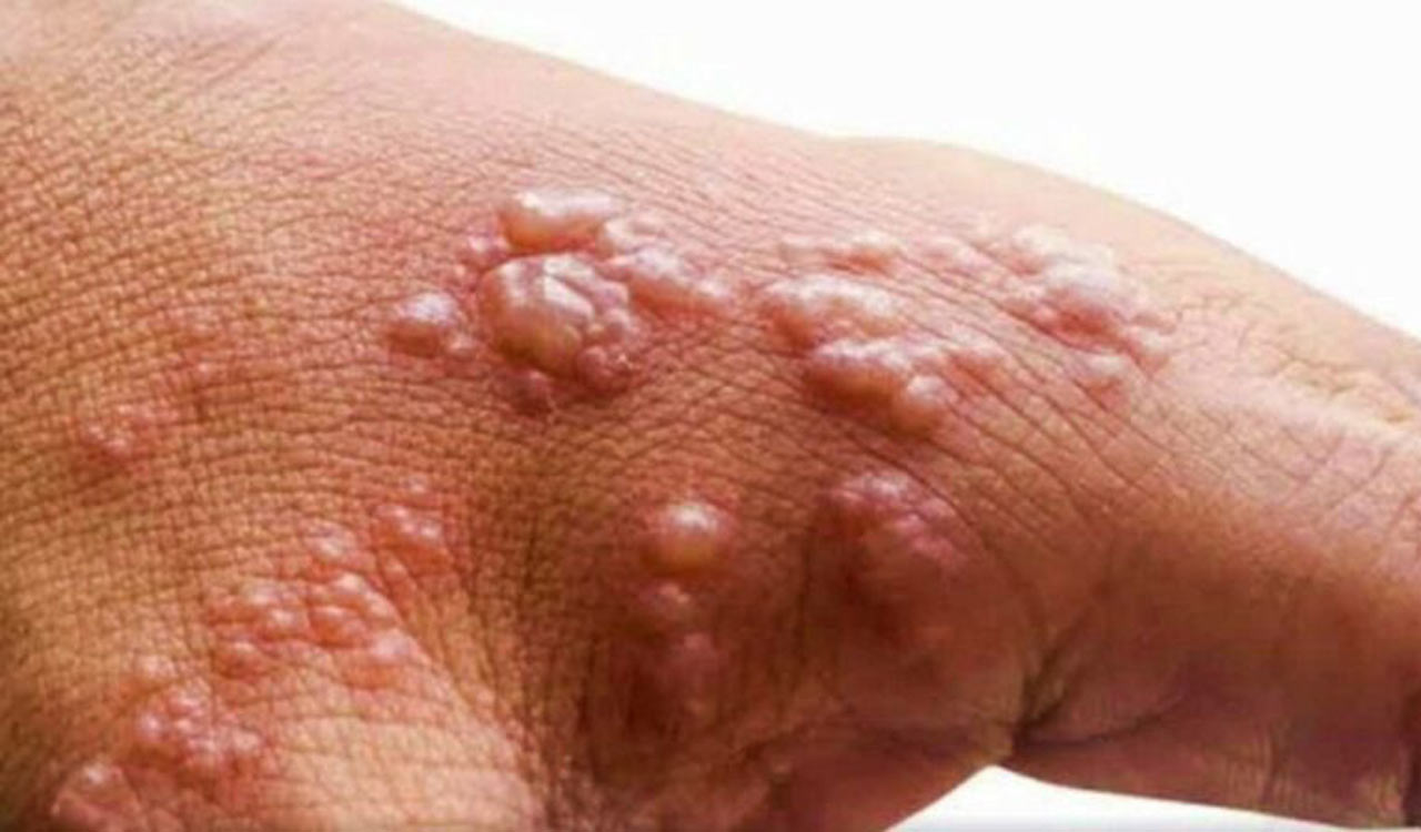 5,236 suspected Mpox cases reported in DR Congo, 229 deaths: WHO