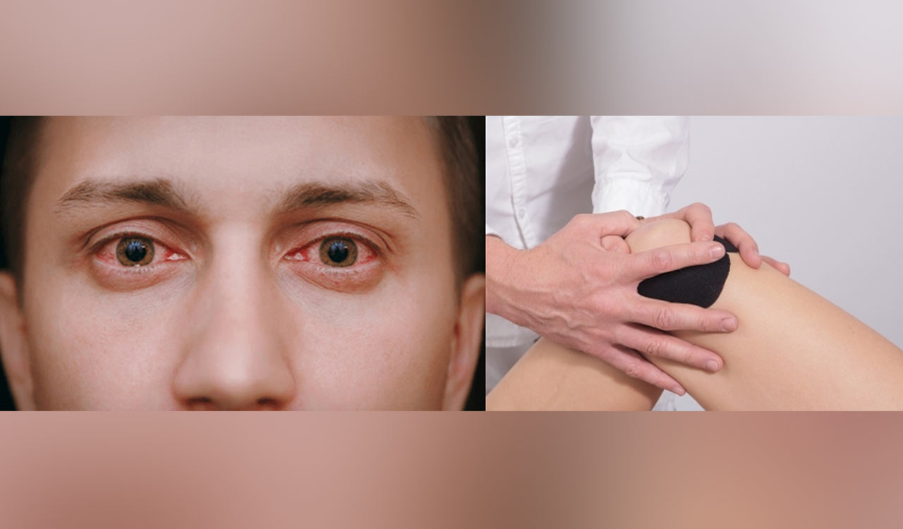 After pink eye, Delhi doctors report 50% rise in joints pain & arthritis