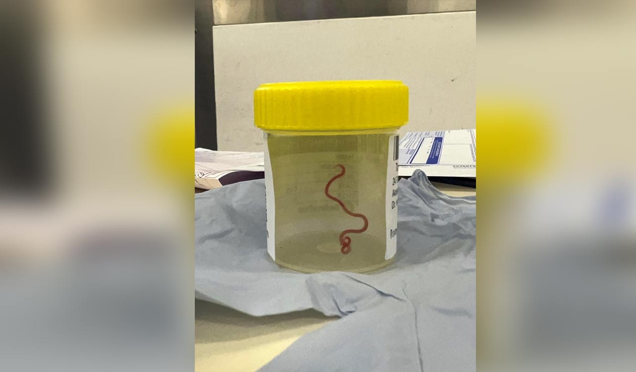 Doctors pull 8-centimetre-long live worm from patient’s brain during surgery