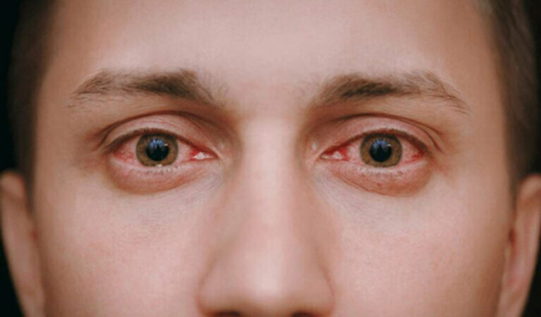 Conjunctivitis 3