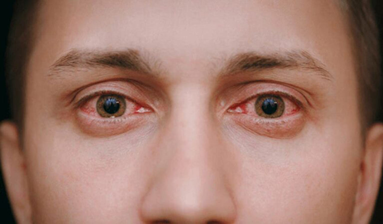 Boost immunity to keep red eye, flu at bay