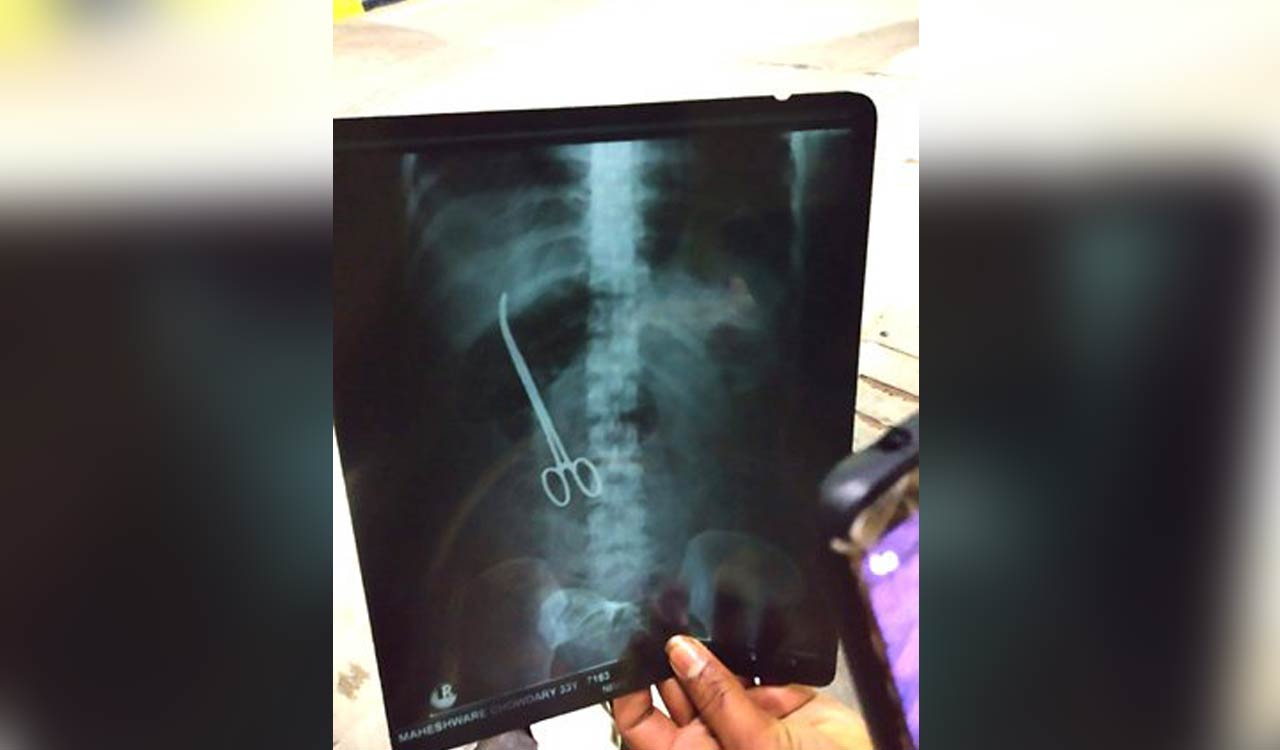 Andhra hospital horror: Forceps left in woman’s stomach during C-Section