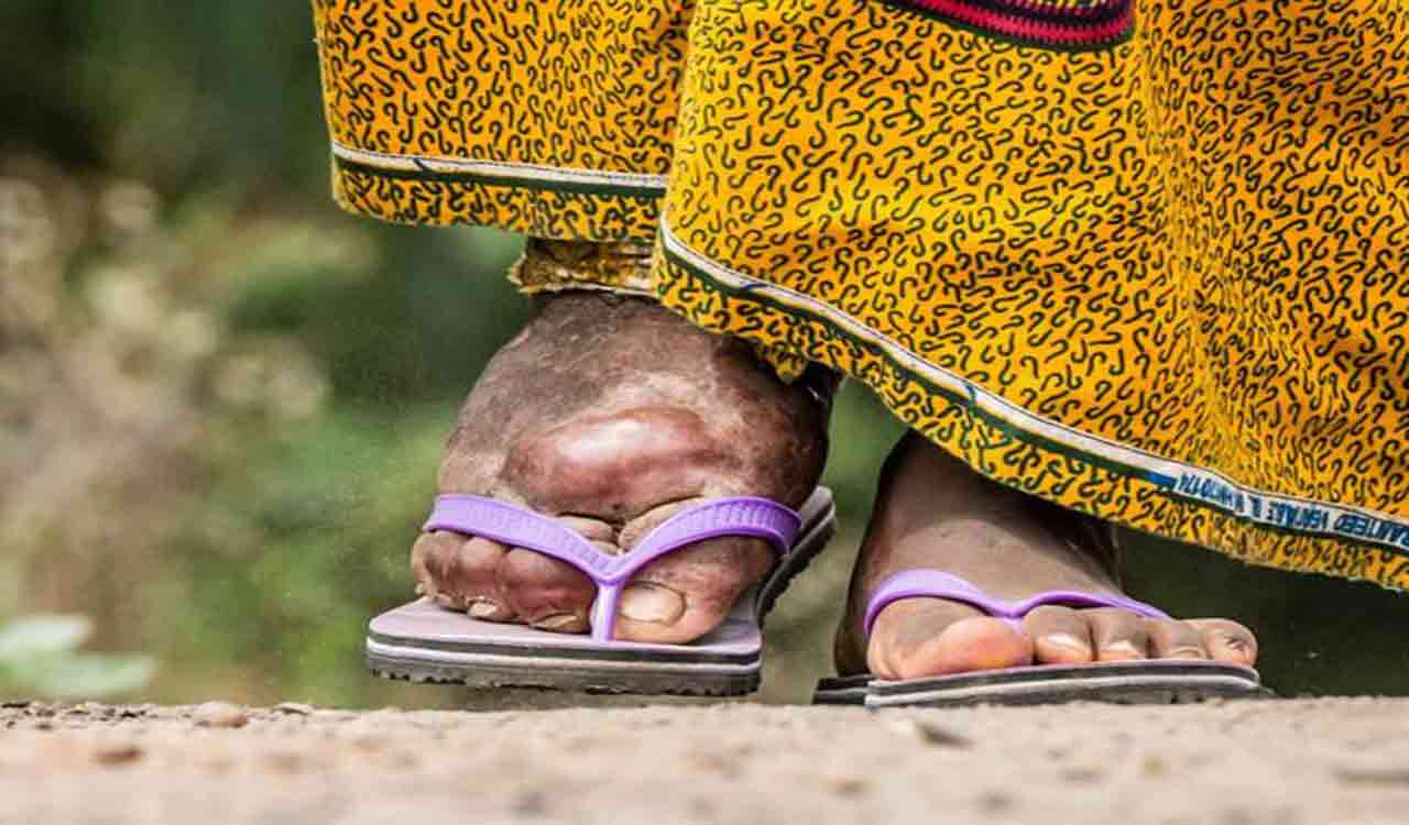 India committed to eradicate Lymphatic Filariasis by 2027: Mansukh Mandaviya