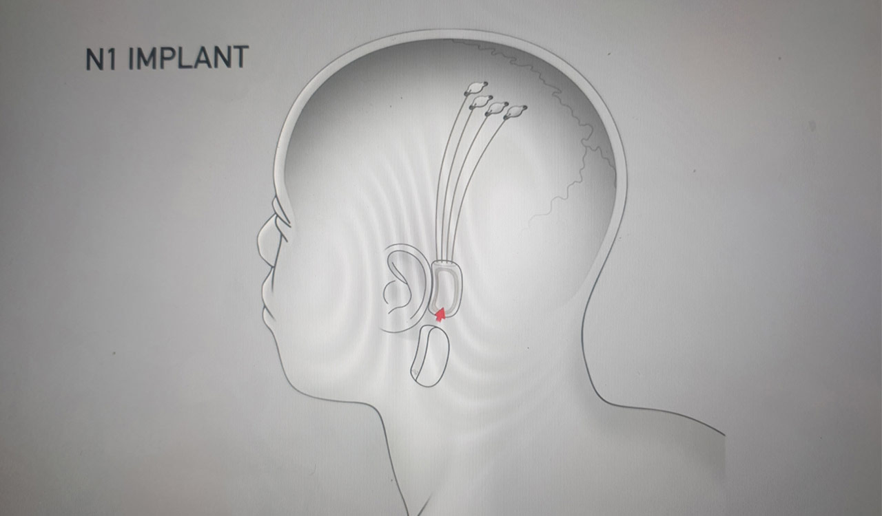 Neuralink begins recruiting for first human brain-computer trial