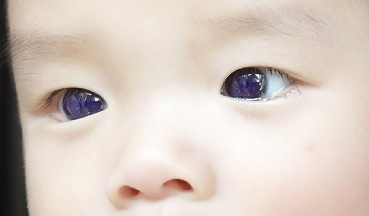 Thai baby’s eye color changes to blue due to COVID antiviral treatment