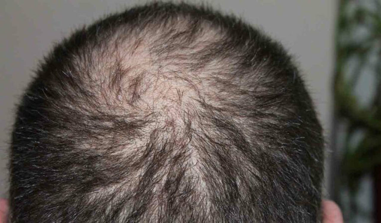 Follow these tips to fight against hereditary hair loss