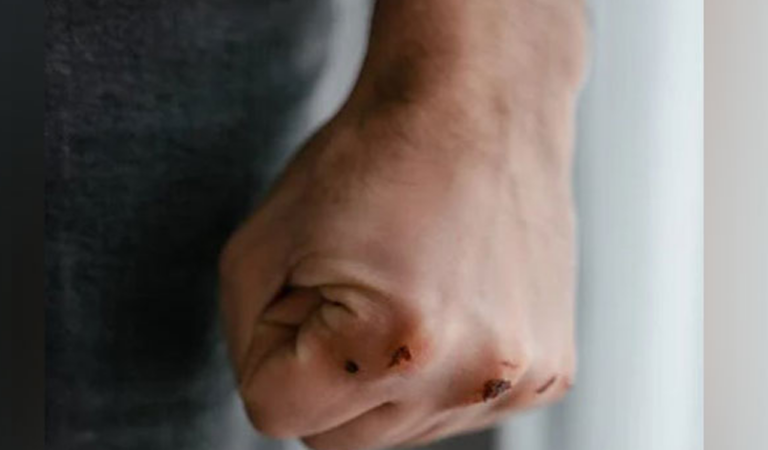 Wound