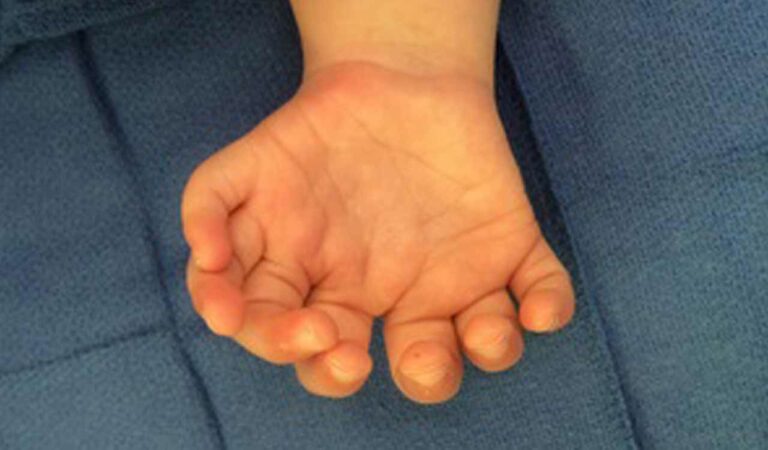 Polydactyly
