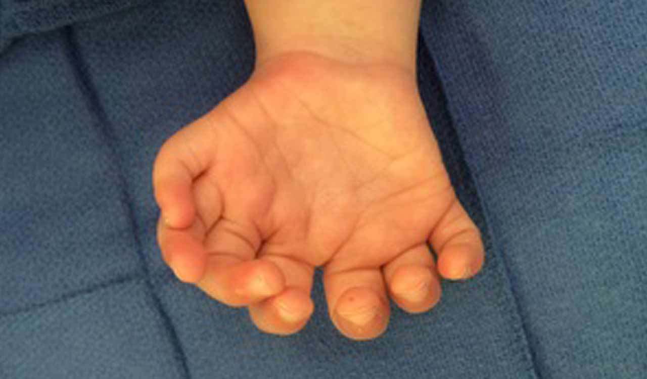 Study finds rare disorder behind extra fingers and toes