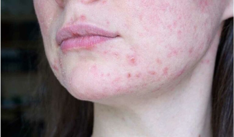 Lupus Nephritis