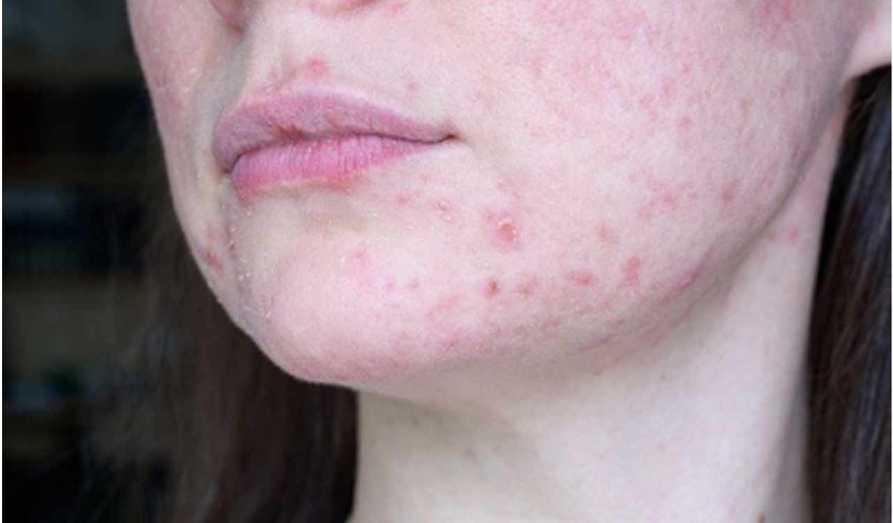 AI may automate diagnosis of lupus nephritis: Report