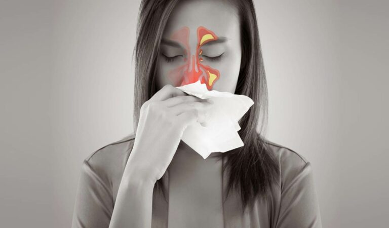Sinusitis