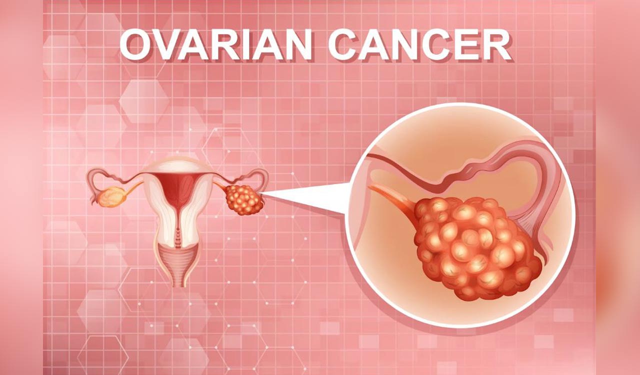 New Method May Detect Early Ovarian Cancer From Urine Test Telangana Today