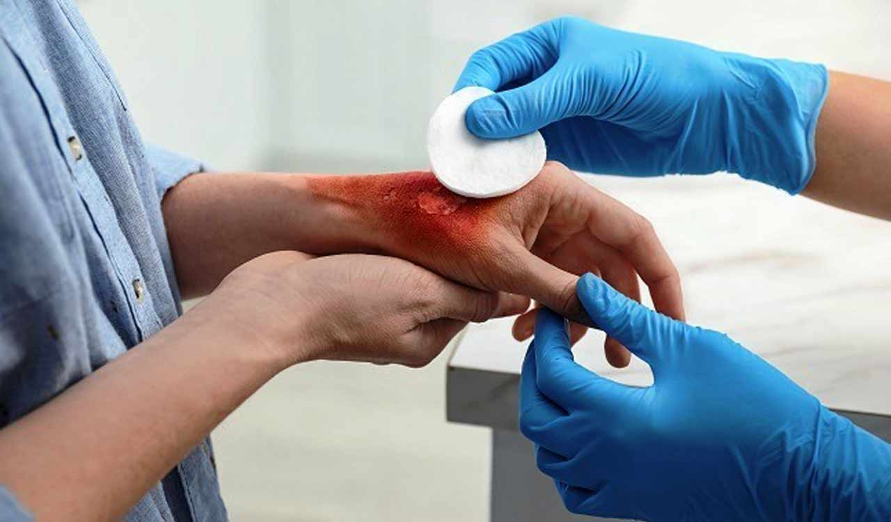 KGMU experts: No ice, no toothpaste for burn injuries