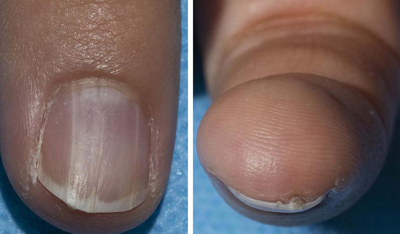 Coloured nail bands may signal cancer risk: Study Finds