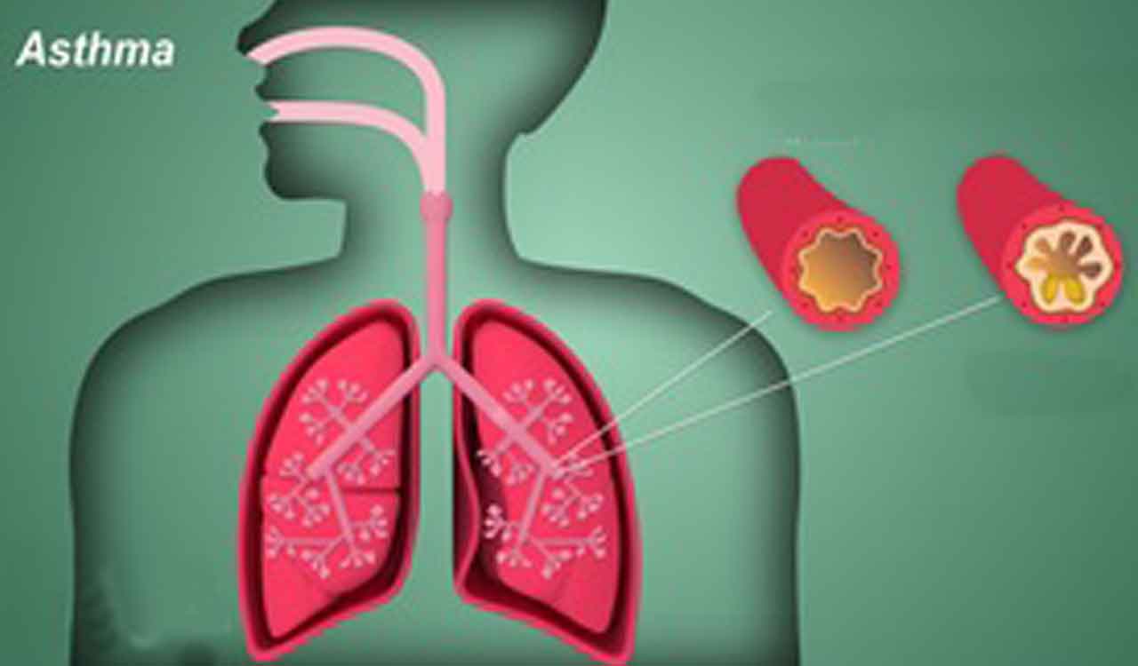 ‘IDIOT’ syndrome hampers asthma treatment: Experts