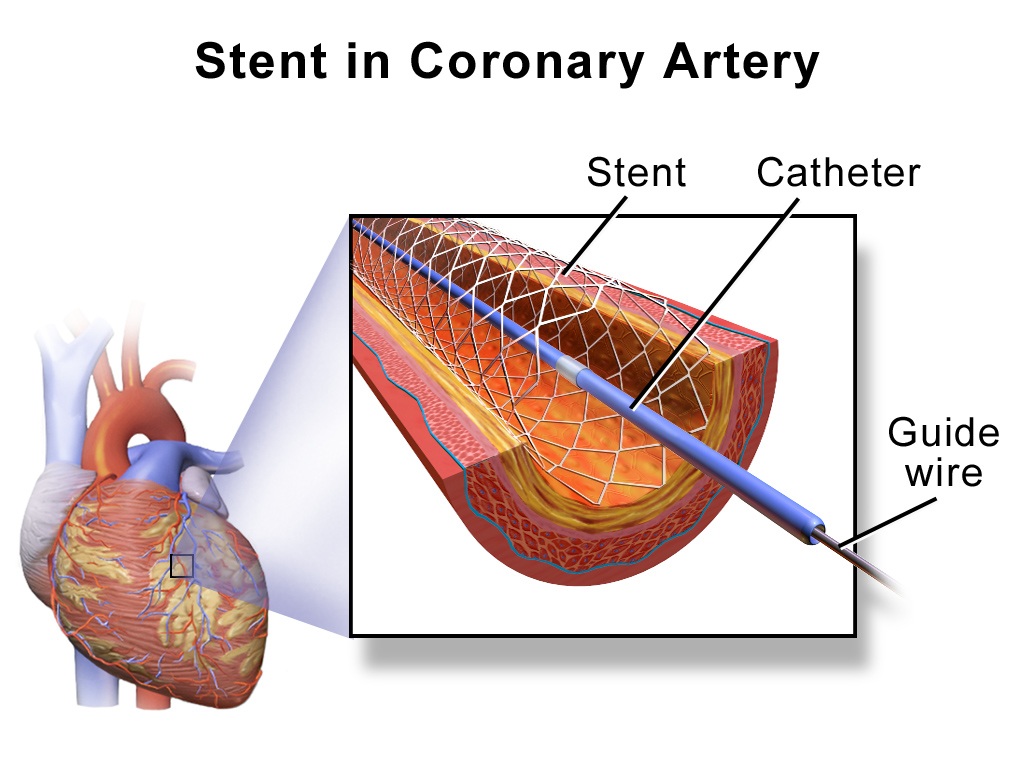 Ceiling price for cardiac stents fixed