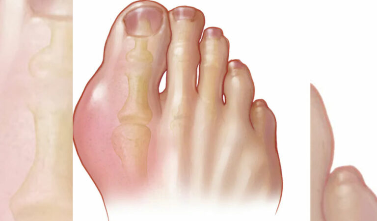 The study estimated gout prevalence and years lived with disability (YLDs) from 1990 to 2020 drawing on population-based data from 35 countries.