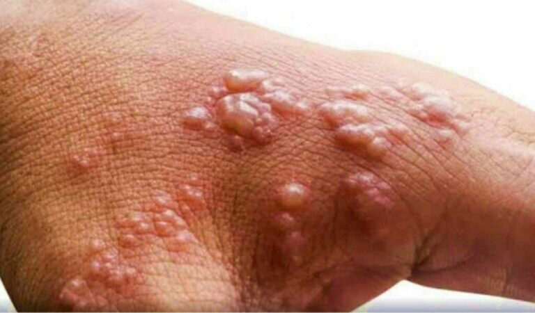 Mpox Cases