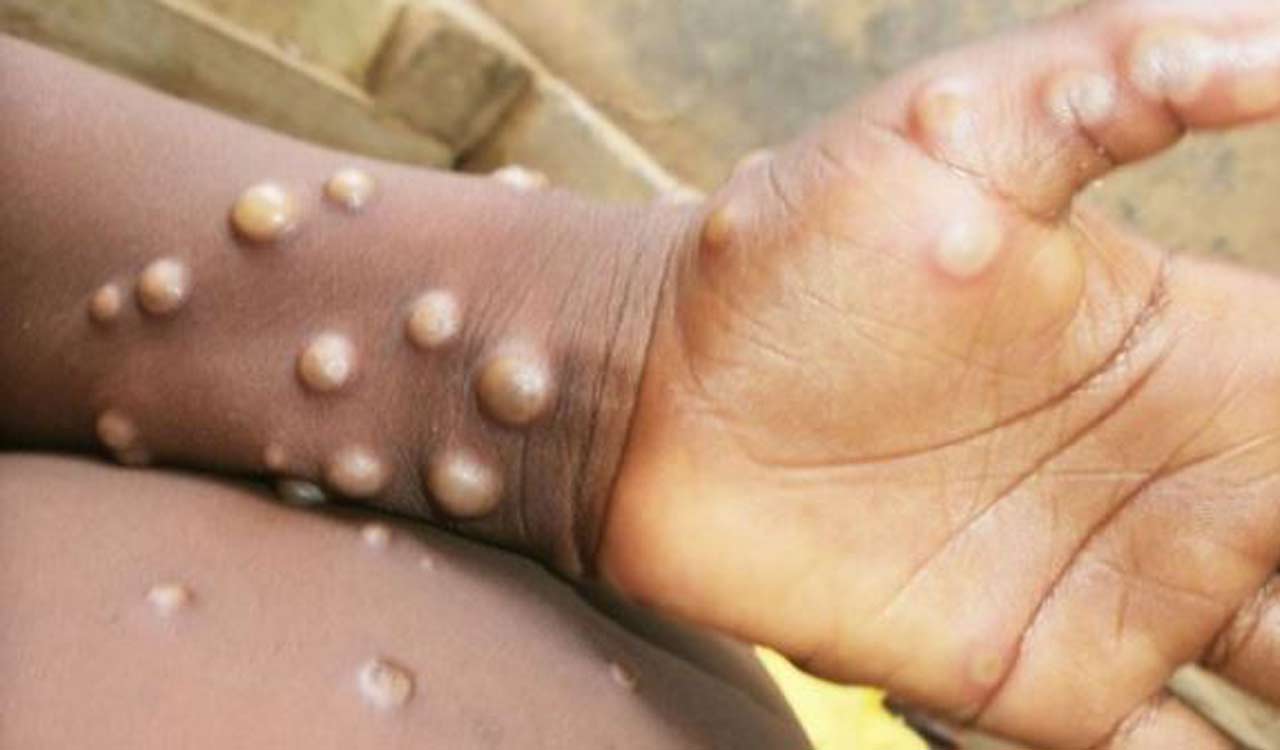 Sweden confirms first case of infectious Mpox variant outside Africa