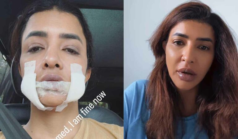 Manchu lakshmi suffers isolated drug allergy