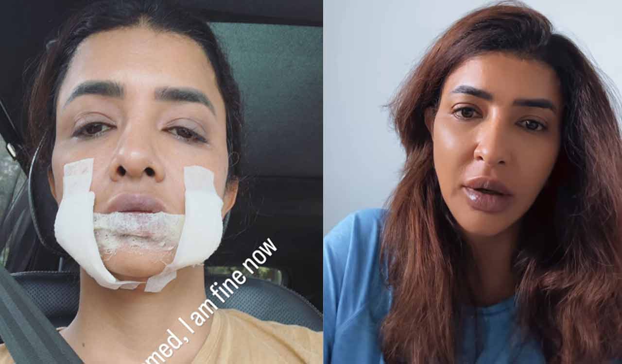 Manchu Lakshmi suffers from isolated drug allergy – Telangana Today