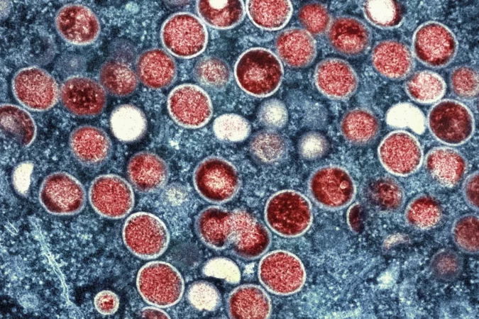 The WHO has declared mpox a global health emergency due to its rapid spread in Africa, particularly in Congo, where over 14,000 cases and 524 deaths have occurred. The virus's new strain may be more transmissible. AP Photo