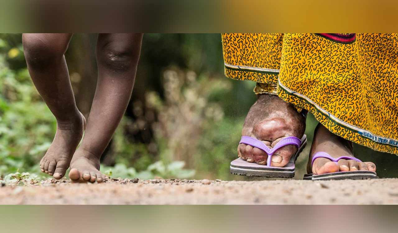 How India is battling Lymphatic Filariasis