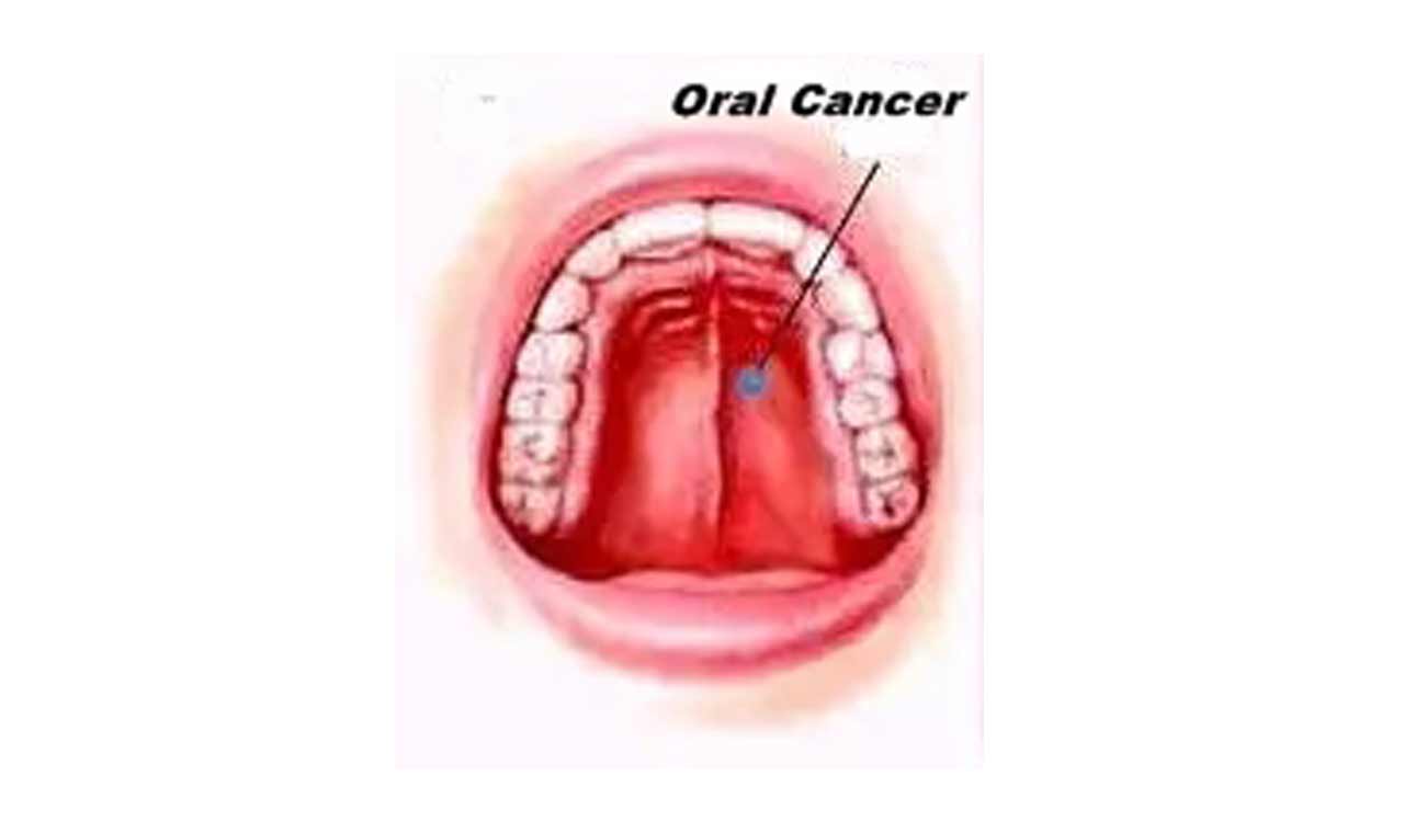 Smokeless tobacco, betel nut fuel oral cancer cases in India: Lancet
