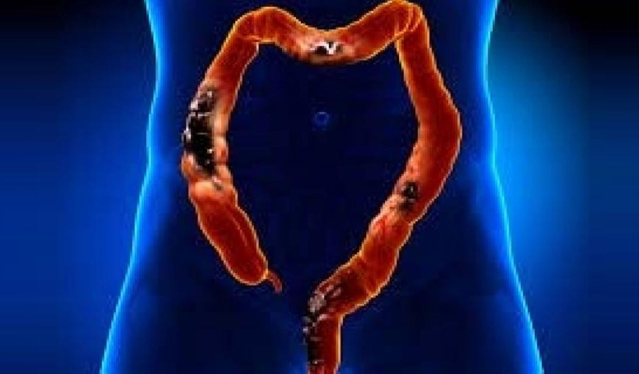 New study reveals stress worsens colorectal cancer