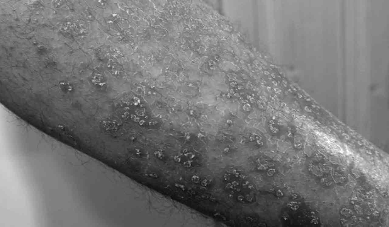Pregnancy hormonal changes may increase Psoriasis risk in 10-20% of women, experts warn