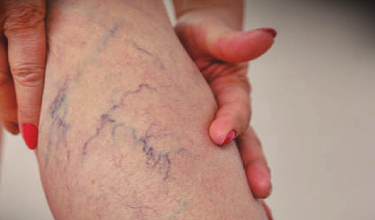 25pc of India’s population affected by varicose veins, treatable without surgery, experts say