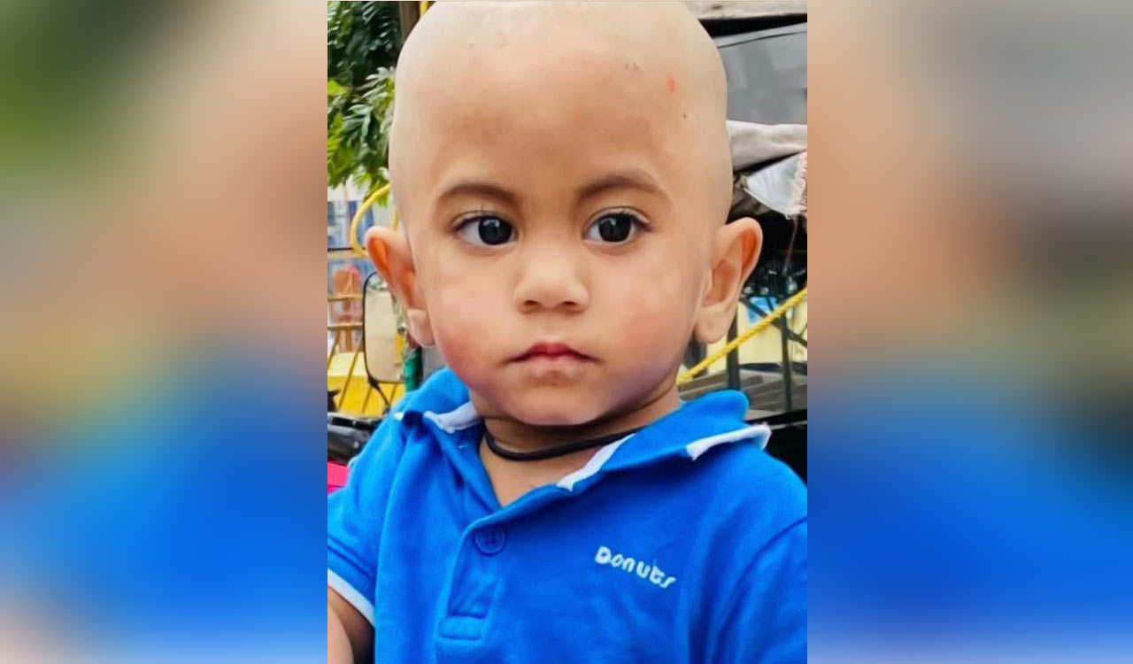 Hyderabad: Kamineni doctors give new lease of life to 3-month-old baby with abnormal brain