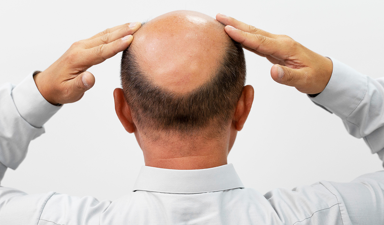 Bald man’s miraculous ‘hair growth’  formula in Meerut lands him in jail!