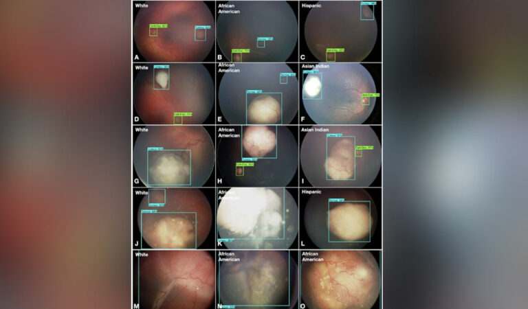 In the new study that was published in the journal Cancers (October, 2024), the researchers said that they have improved ArMOR and tested its ability to detect retinoblastoma in a multiracial patient group or cohort.