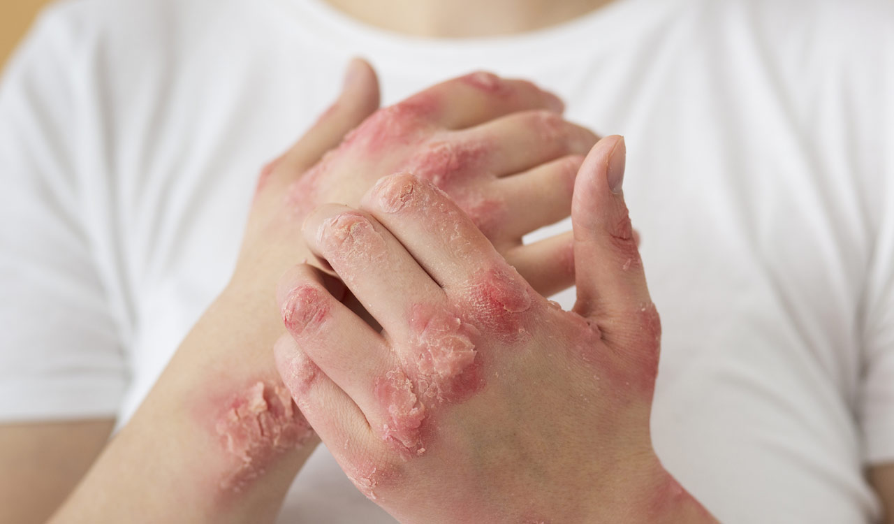 Rise in skin health issues due to low temperatures, AQI in Hyderabad